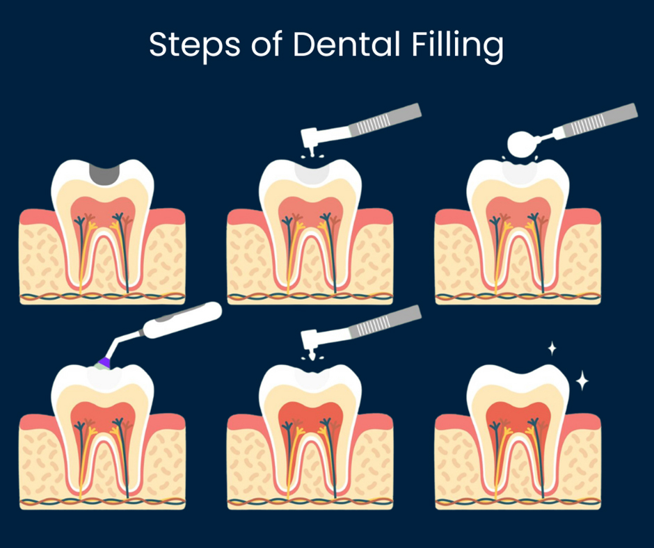 Dental Fillings Process